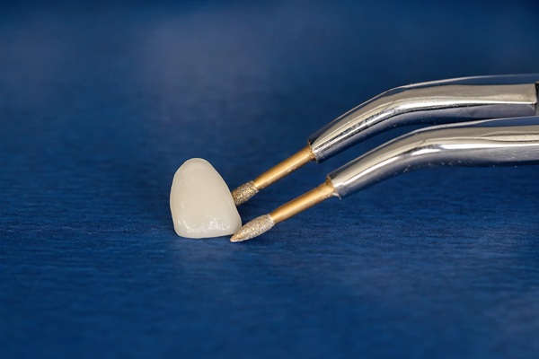 Dental Crowns And Front Teeth: What You Should Know
