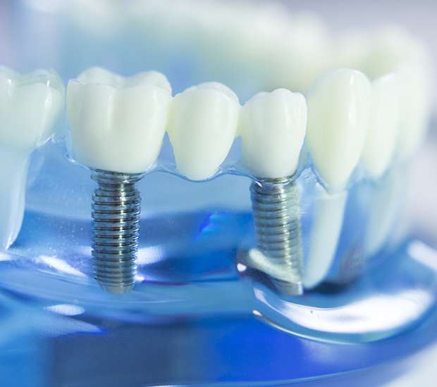 Dumont Dental Implants