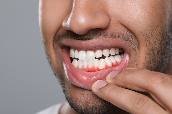 Gingivitis To Periodontitis: The Stages Of Gum Disease